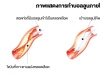 โรคหลอดเลือดหัวใจตีบเป็นอย่างไร?